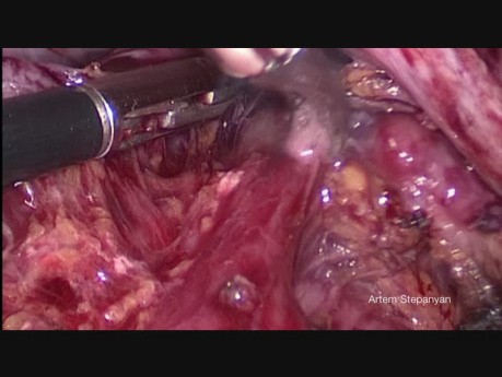 Zytoreduktive Chirurgie (CRS) bei Eierstockkrebs und laparoskopische Peritonektomie im Becken