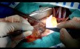 Reparatur von Ventrikelseptumdefekten nach Myokardinfarkt