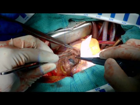 Reparatur von Ventrikelseptumdefekten nach Myokardinfarkt