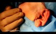 Präaurikulärer Zugang – wie man ihn durchführt