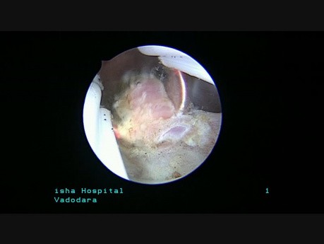 Endometriumpolyp an der hinteren Wand