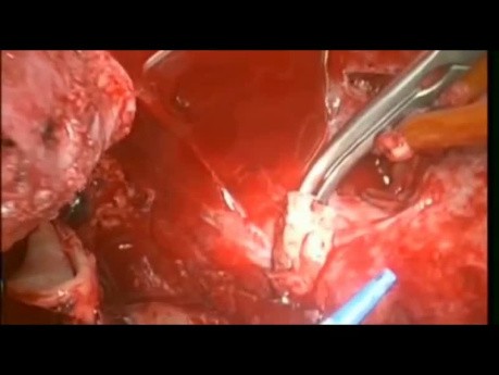 Herz-Autotransplantation bei rezidivierendem Sarkom