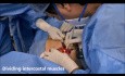 Resektion des Chondrosarkoms der Brustwand unter Kontrolle der Videothorakoskopie (VATS)
