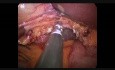 SILS Cholezystektomie - mit Gelpoint und Gelenkhaken