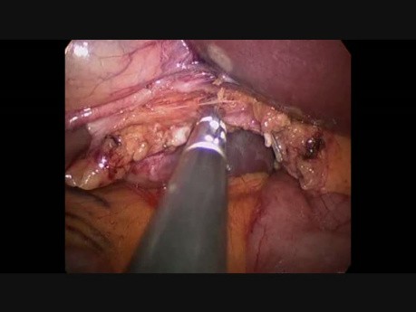 SILS Cholezystektomie - mit Gelpoint und Gelenkhaken