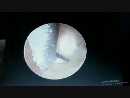 Septumresektion durch die Hysteroskopie