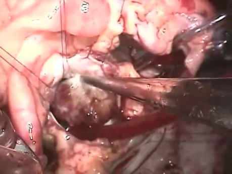 Tumor des Herzens Operation