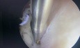Endometrium-Polyp