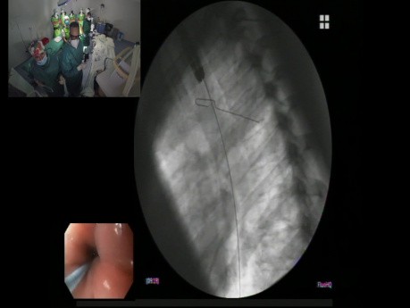 Ösophagus-Stent-Verfahren