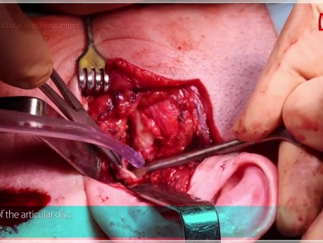 Totale alloplastische Kiefergelenkersatzoperation