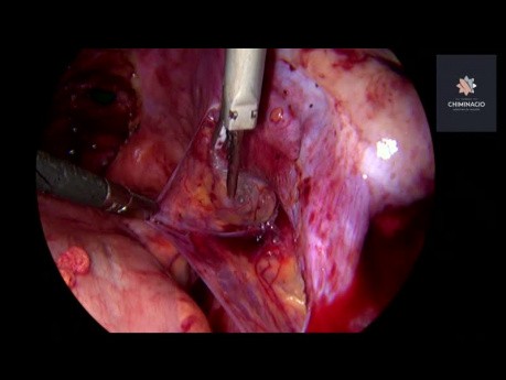 Behandlung der tief infiltrierenden Endometriose (TIE)