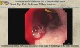 Aortenokklusionsballon zur Hämostase bei akuter oberer gastrointestinaler Blutung – Mini-Operationsvideo