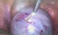 Laser in Endometriosis 