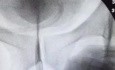 Ballondilatation einer komplizierten Harnröhrenstriktur