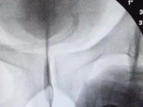 Ballondilatation einer komplizierten Harnröhrenstriktur