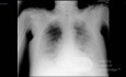 COVID-19- Röntgen-Thorax (1)