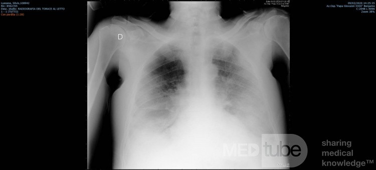 COVID-19- Röntgen-Thorax (1)
