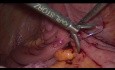 Palliative laparoskopische Ileotransversostomie