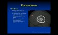 Kurs Orthopädische Onkologie - Gutartige Knorpeltumoren (Osteochondrom, Chondroblastom etc.) - Vortrag 5