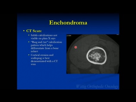 Kurs Orthopädische Onkologie - Gutartige Knorpeltumoren (Osteochondrom, Chondroblastom etc.) - Vortrag 5
