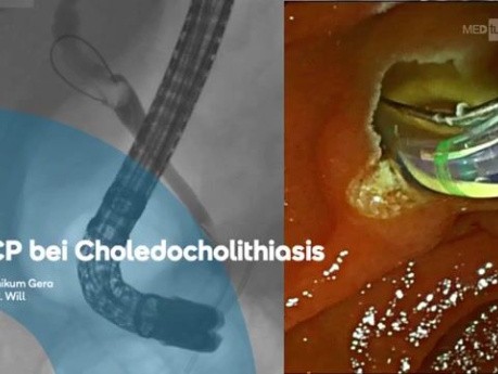 ERCP bei Choledocholithiasis