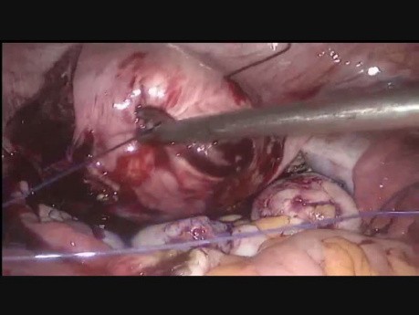 Myomektomie zahlreicher Uterusmyome mit Vicryl-Naht
