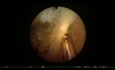 Enukleation der Prostata mit dem GreenLight-Laser