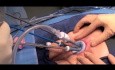 Transanale minimalinvasive Chirurgie - Modifikation