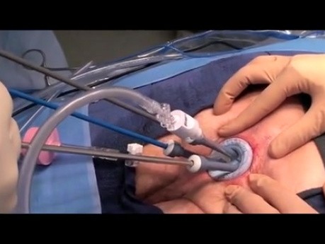 Transanale minimalinvasive Chirurgie - Modifikation