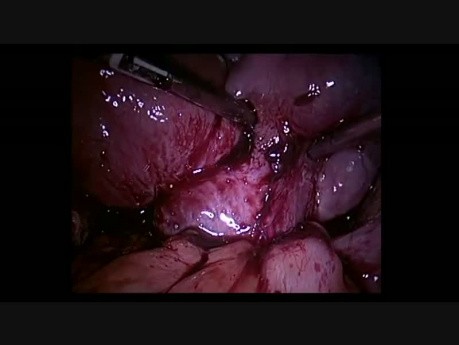 Schokoladenzyste und Endometriose