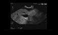 Endoskopischer Ultraschall der Striktur des gemeinsamen Gallengangs