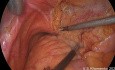Klinischer Fall einer langen Striktur des linken Ureters