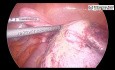 Laparoskopische Oophorektomie bei Ovarialtorsion