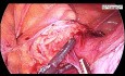 Totale laparoskopische Hysterektomie- Uterus myomatosus