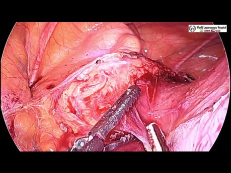 Totale laparoskopische Hysterektomie- Uterus myomatosus