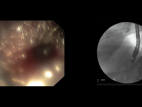 Gastrostomie der Bauchspeicheldrüse