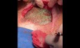 Brustwandrekonstruktion nach einem Trauma mit Titangitter 