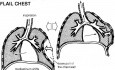 Der Mechanismus den instabilen Thorax