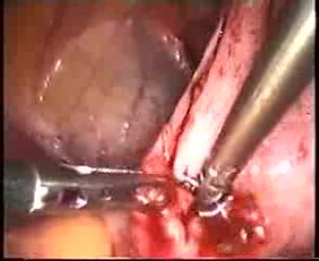 Tief infiltrierende Endometriose