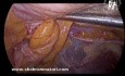 Pantaloon-Hernien-Laparoskopie