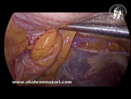 Pantaloon-Hernien-Laparoskopie