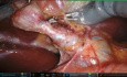 Robotische Cholezystektomie über einen suprapubischen Bikini-Schnitt mit Cholangio-ICG und intraoperativer Cholangiographie (IOC)