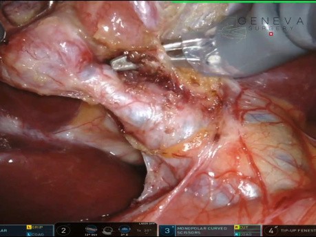 Robotische Cholezystektomie über einen suprapubischen Bikini-Schnitt mit Cholangio-ICG und intraoperativer Cholangiographie (IOC)