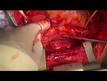 Rechtes Hemithorax-Sarkom