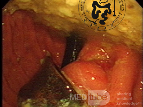Magenbanderosion – endoskopisches Bild