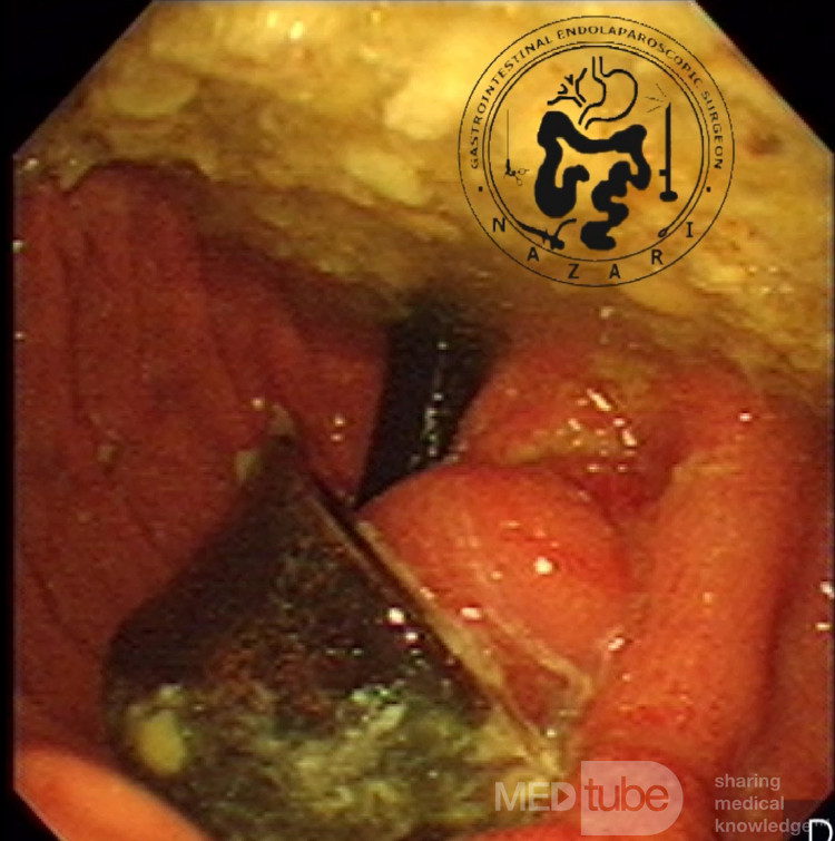 Magenbanderosion – endoskopisches Bild