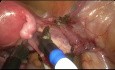Robotisch-assistierte vaginale Hysterektomie
