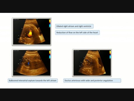 Restriktives Foramen Ovale in der Fetalperiode und im postnatalen Prozess