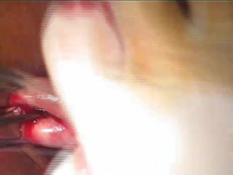 Entfernung der Gebärmutter durch die Vagina, Teil 1
