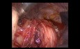 Thorakoskopische Ösophagus-Leiomyom-Chirurgie